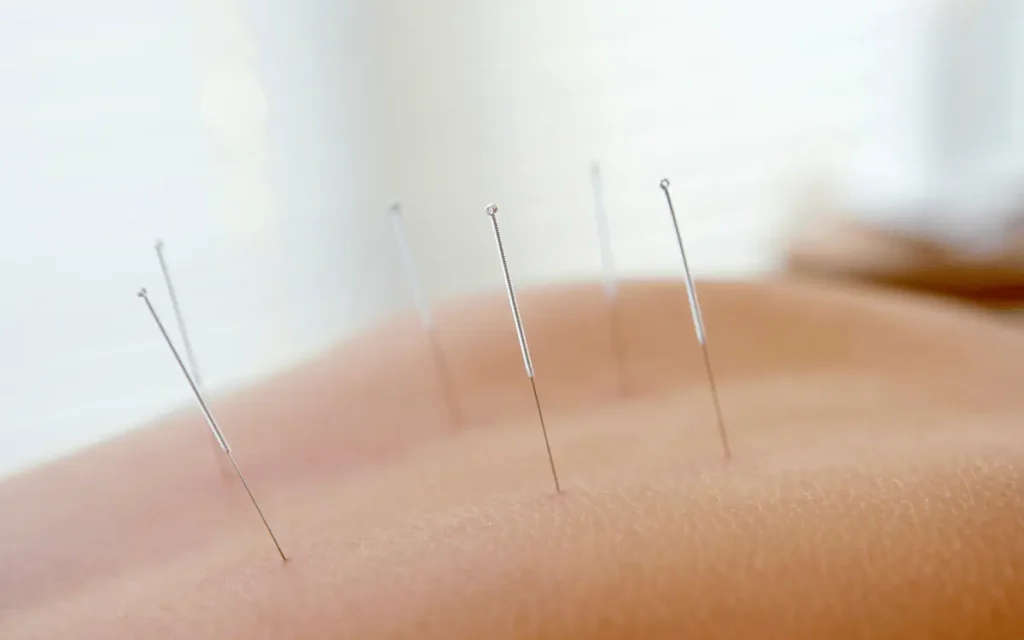 Acupuncture Session