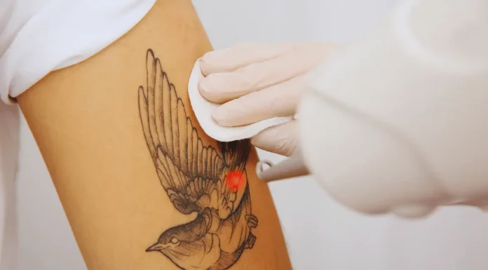 How to Estimate the Cost of Having a Tattoo Removed Tattoo removal