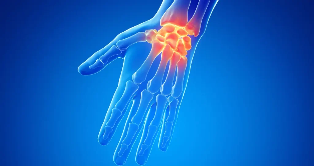 Wrist Pain Illustration